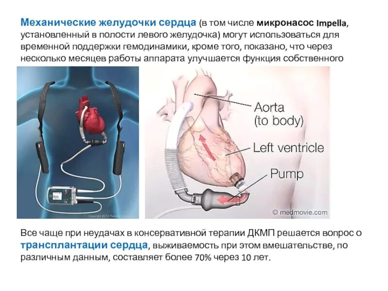 Механические желудочки сердца. Искусственный желудочек сердца. Искусственный левый желудочек сердца. Механический левый желудочек сердца.
