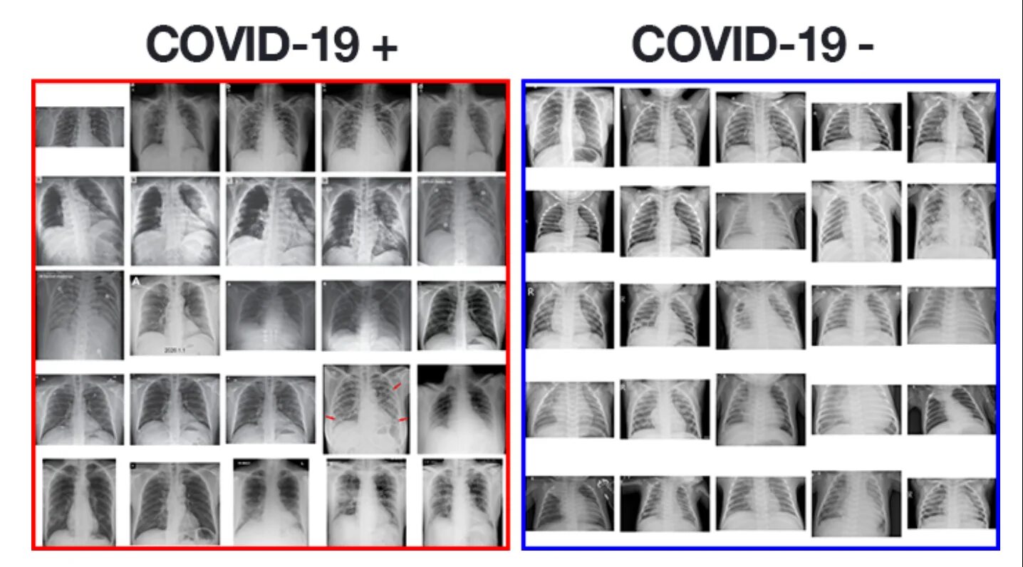 Отличить ковид. Ковид 19 рентген. Ковид на рентгеновском снимке. Классификация рентгеновских снимков. Снимок легких при ковид.