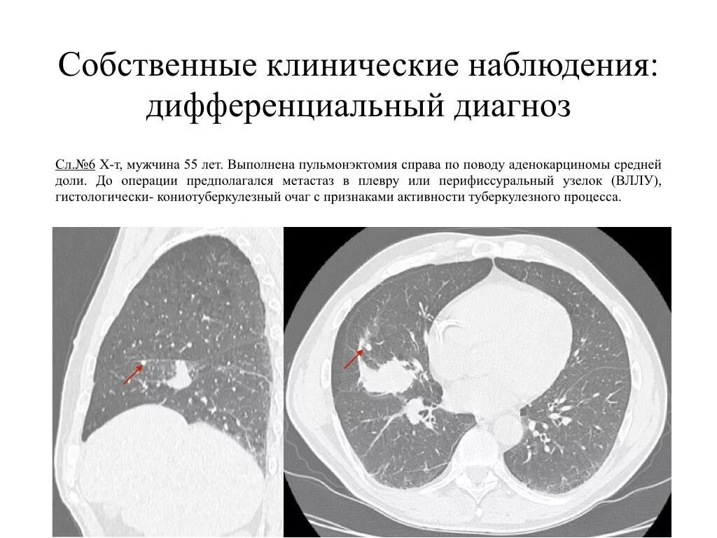 Внутрилегочные лимфоузлы на кт легких. Лимфатические узлы в легких на кт. Кальцинаты в лимфоузлах