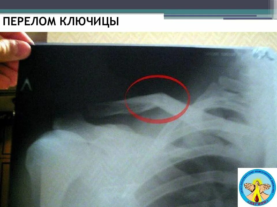 Сколько срастается ребро при переломе