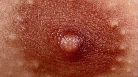 White bump on nipple male 🔥 DERM DX: What Are These Areolar Papules.
