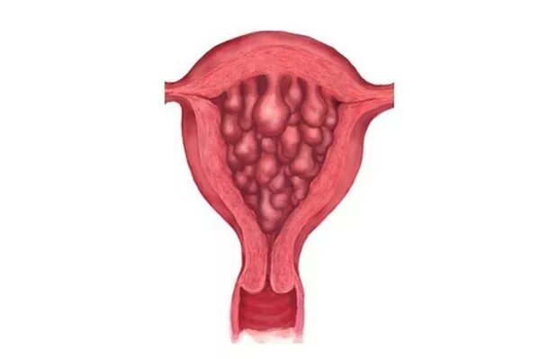 Гиперплазия матки в менопаузе чем опасно. Кистозная гиперплазия эндометрия. Гипертрофия эндометрия матки что. Отторжение слизистой оболочки матки. Гиперплазия эндометрия матки что это.
