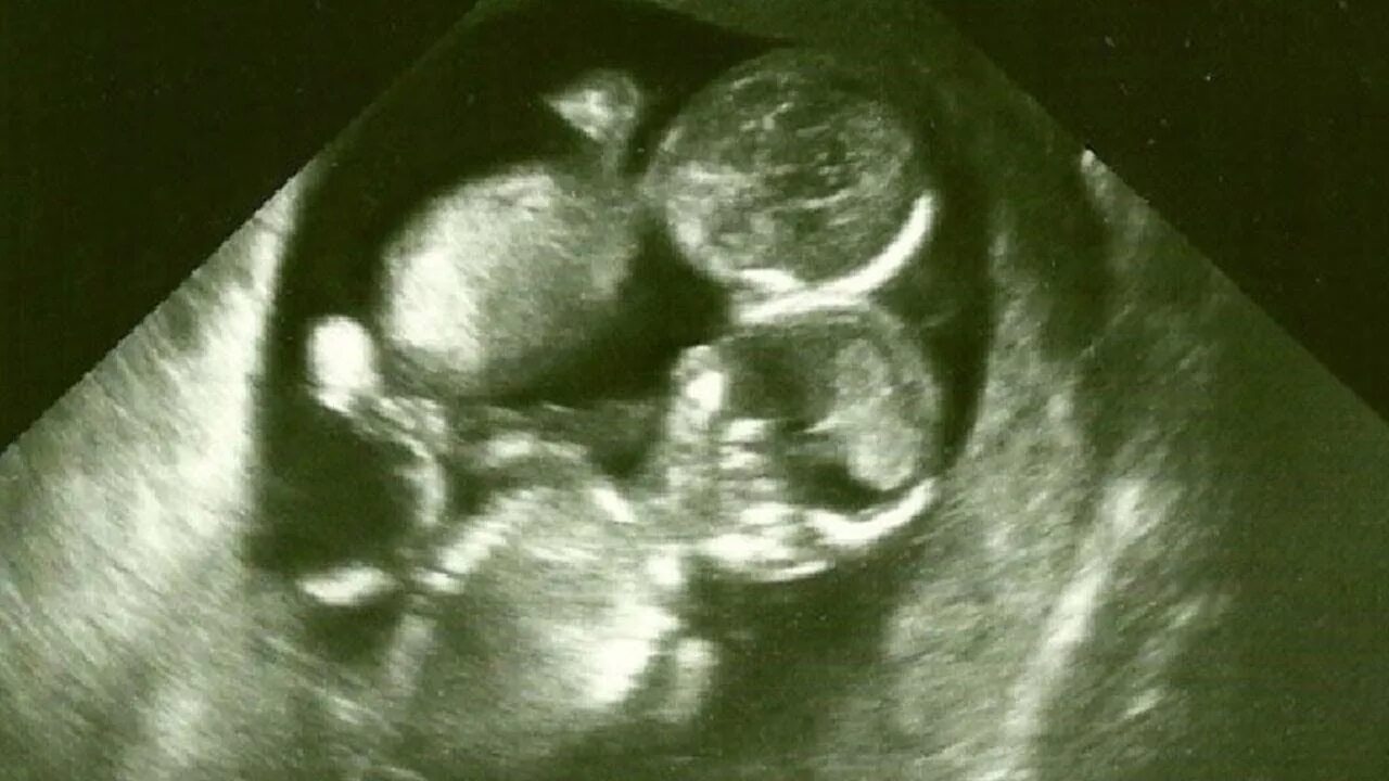 Малыш на 16 неделе беременности УЗИ. УЗИ на 16 неделе беременности двойня. УЗИ детей в животе 22 недели беременности двойня. 16 недель 3 5