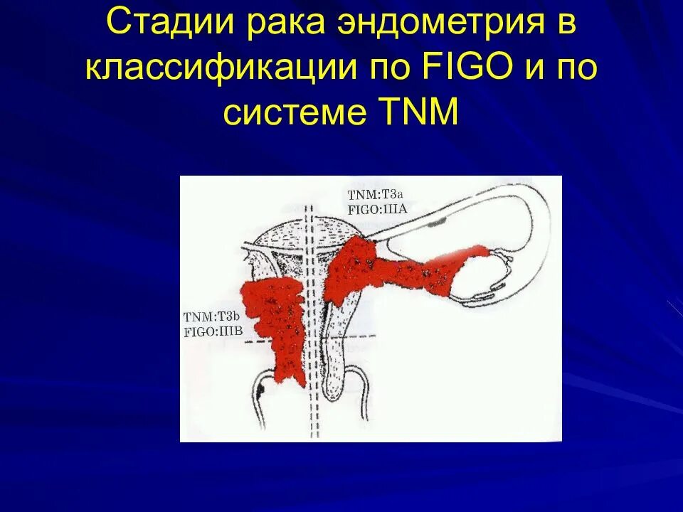 Рак 0 матки. Классификация стадий эндометрия. Классификация TNM опухолей матки. Классификация Figo тело матки.