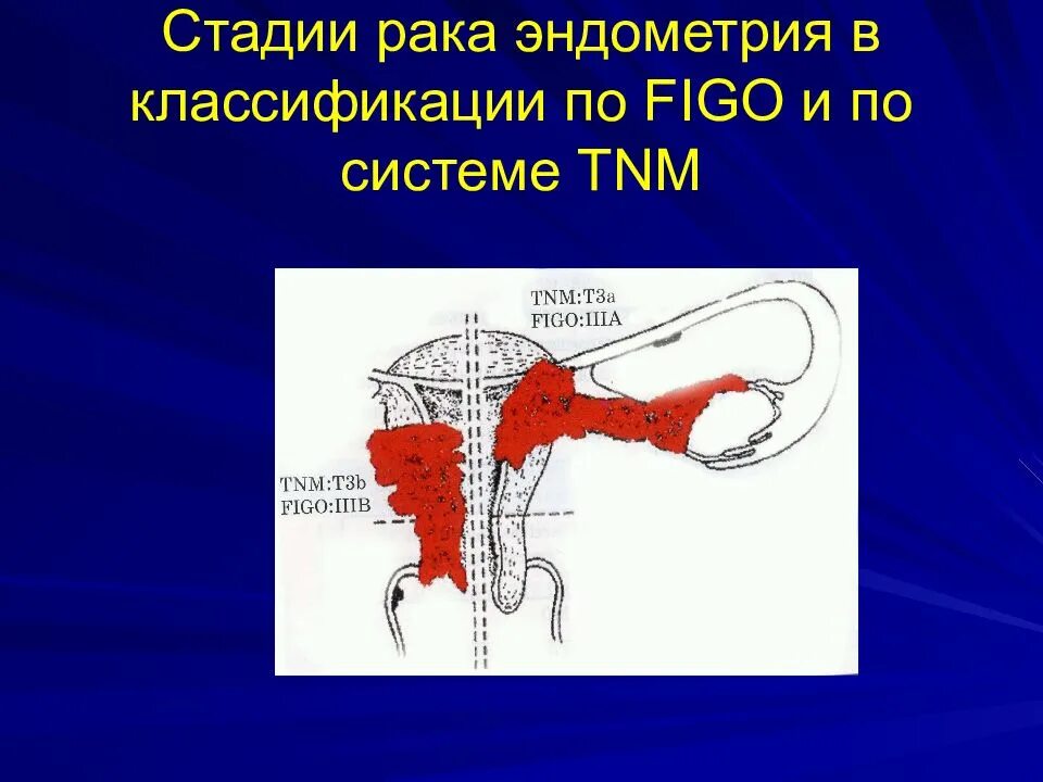 Симптомы рака эндометрия