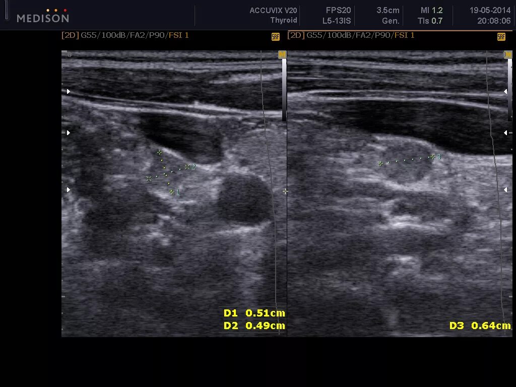 Медуллярная карцинома щитовидной железы на УЗИ. Сонография щитовидной железы. Фолликулярная неоплазия щитовидной железы УЗИ. Как выглядят узлы в щитовидной железе на УЗИ. Щитовидная железа узи лимфоузлы