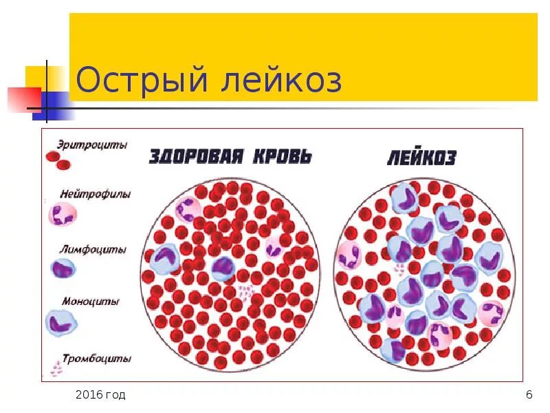 Лейкоз значение. Острый лимфобластный лейкоз костный мозг. острый лейкоз (лейкемия).