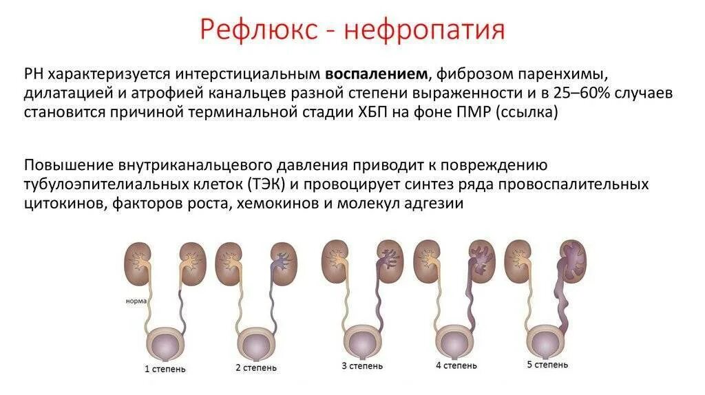 Рефлюкс почек. Пузырно-мочеточниковый рефлюкс классификация. пузырно-мочеточниковый рефлюкс аномалии развития почек. пузырно-мочеточниковый рефлюкс стадии. пузырно-мочеточниковый рефлюкс этиология.