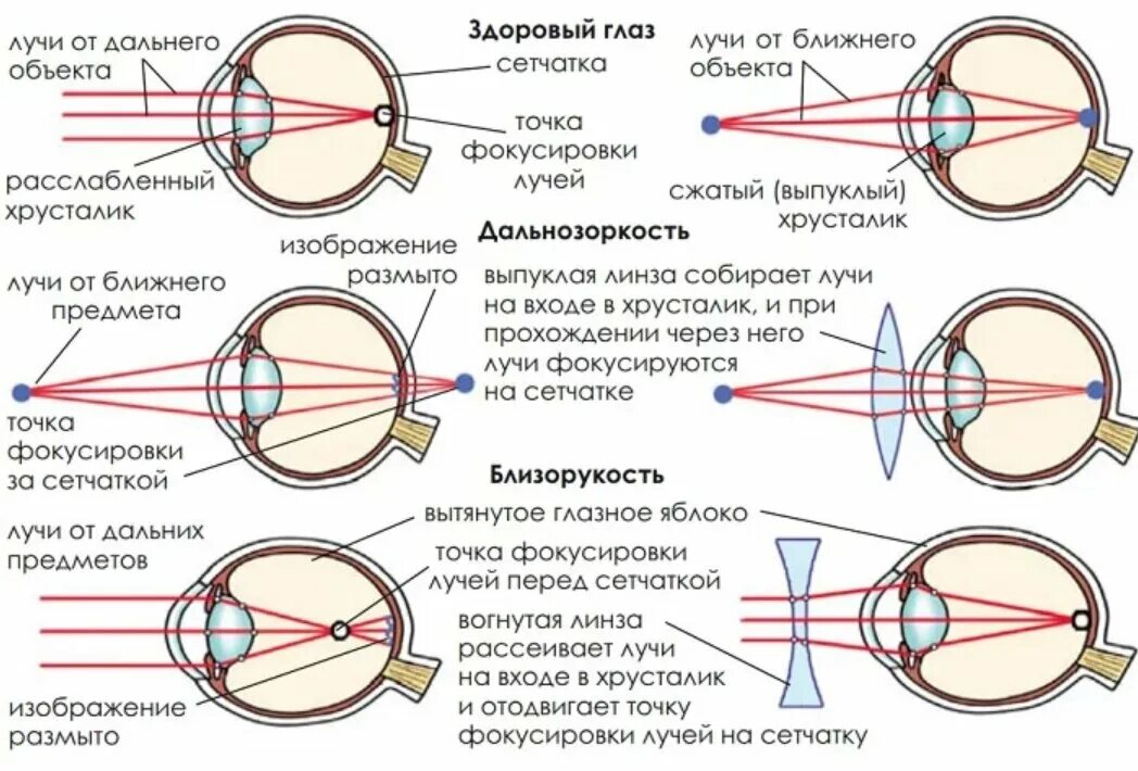 Ход лучей близорукость и дальнозоркость. Близорукость и дальнозоркость схема рефракции. Схемы рефракции при нормальном зрении. Схема строения глазного яблока при близорукости и дальнозоркости. Зрение ниже 3