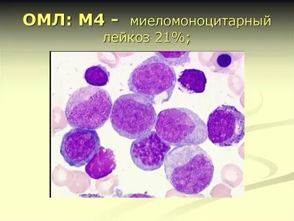 Острый моноцитарный лейкоз