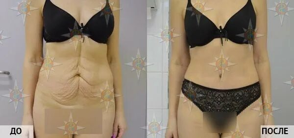 Абдоминопластика до и после. Фартук на животе можно убрать. Абдоминопластика восстановительный период. Абдоминопластика фартук на животе. Фартук на животе можно убрать.