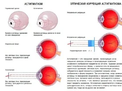 Астигматизм цилиндр