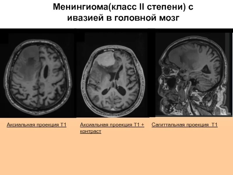 Доброкачественная опухоль головного мозга сколько живут