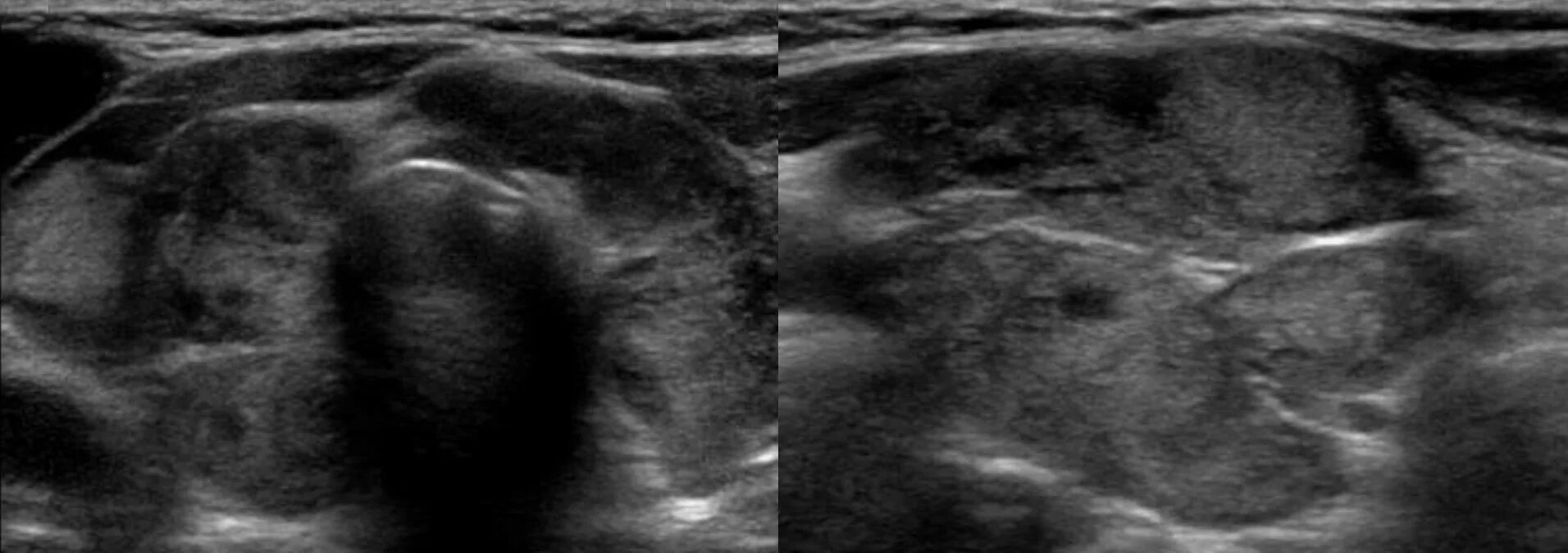 УЗИ щитовидной железы заключение АИТ. Признаки АИТ на УЗИ щитовидной железы это. УЗИ картина узлового зоба. Диффузно узловая форма