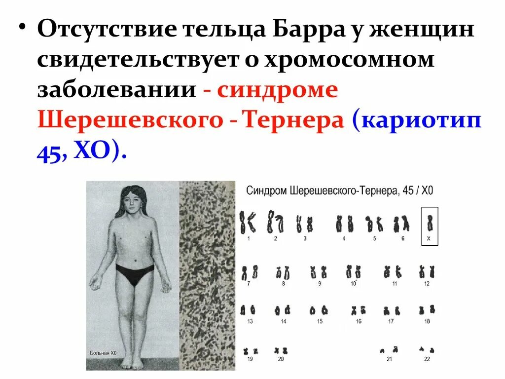 Синдром тельца. Шерешевского-Тернера, кариотип 45хо. Синдром Клайнфельтера и Шерешевского Тернера. Телец Барра синдром Клайнфельтера. Кариотип при синдроме Клайнфельтера.