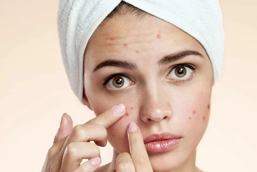 Acne program