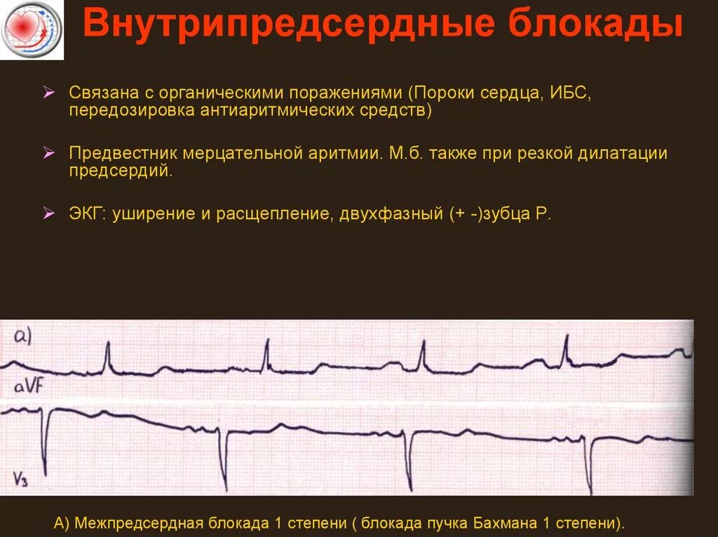 Что значит внутрипредсердная внутрипредсердная блокада. Блокада Бахмана 1 степени. Внутрипредсердная блокада 2 степени на ЭКГ. Межпредсердная блокада 1 степени что это такое на ЭКГ. Внутрипредсердные блокады на ЭКГ.