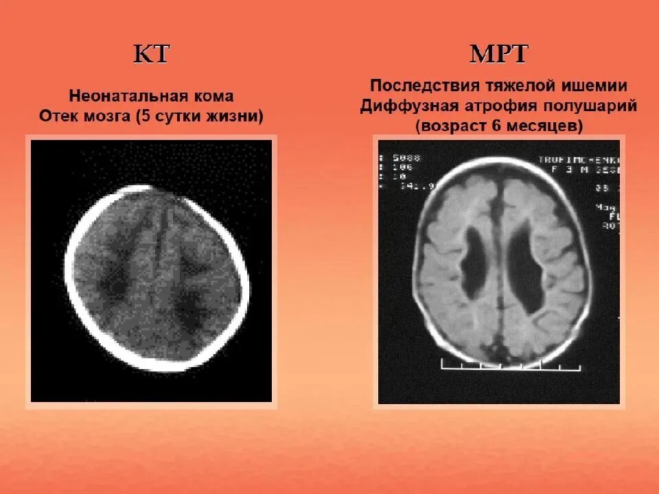 Гипоксическое поражение головного мозга кт. Гипоксически- ишемическое поражение ЦНС кт. Гипоксическая энцефалопатия на мрт. Гимоксияески ишемический поражения головного мозга.