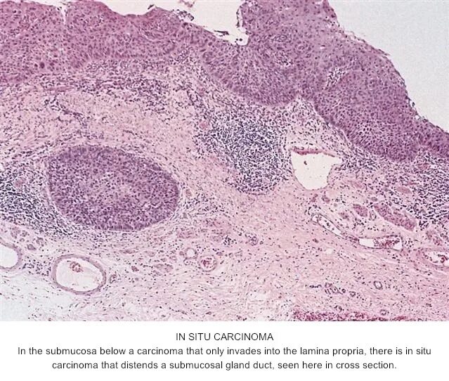 Карцинома шейки матки гистология. Карцинома матки гистология. Плоскоклеточная карцинома шейки матки гистология. Карцинома in situ микропрепарат. Рак in situ шейки