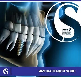 Импланты нобель отзывы