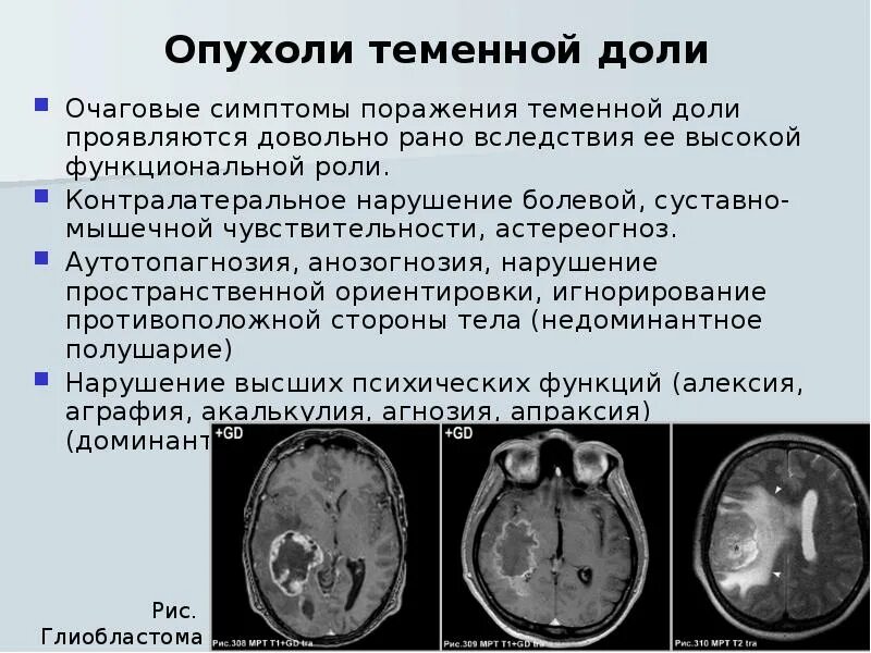 Симптомы опухоли головного мозга на ранних стадиях. Проявления поражения теменной доли.. Опухоль теменной доли головного мозга. Опухоль теменной доли головного мозга симптомы.