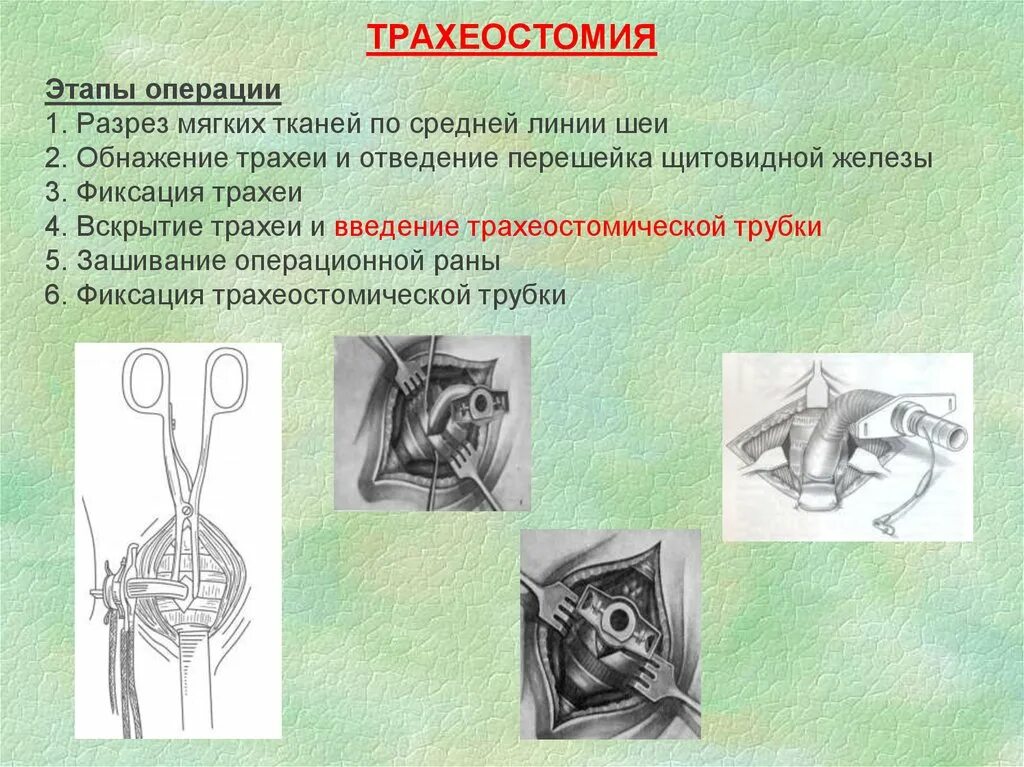 Трахеостомия топографическая анатомия этапы. Трахеостомия Оперативная хирургия техника. Трахеостомия ориентиры. Трахеостомия алгоритм хирургия. Назовите этапы операции