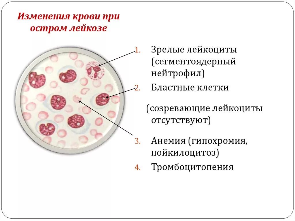 Периферическая кровь при лейкозах