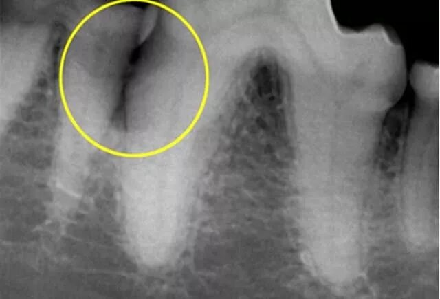 Фиброзный периодонтит. Гангренозный пульпит рентген. Гангренозный периодонтит. Хронический пульпит рентген. Пульпит на рентгеновском снимке.