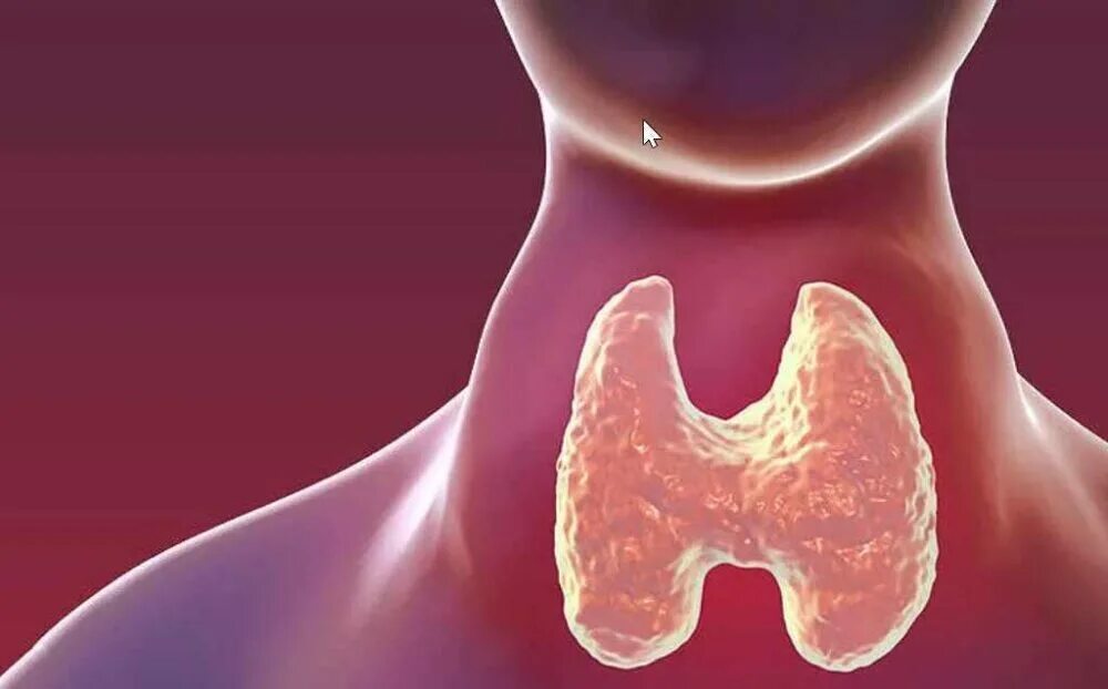 Тиреоидит аутоиммунный тиреоидит. Патология щитовидной железы. Аутоиммунные заболевания щитовидной железы тиреоидит. Аутоиммунный тиреоидит зоб. Аутоиммунный зоб