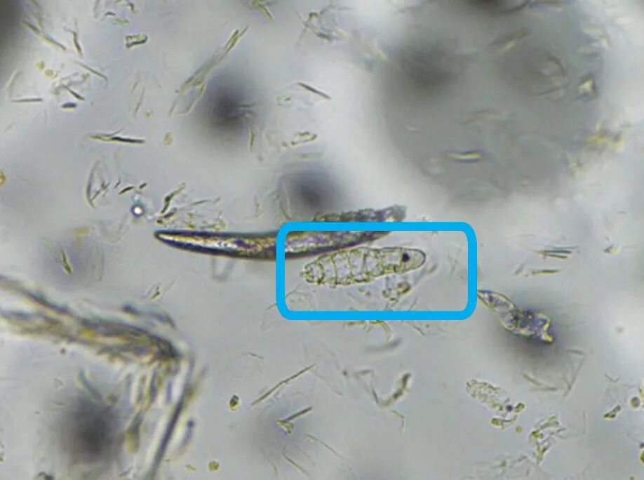 Вы ЭТО должны увидеть (фото клеща демодекс) - Demodex Complex