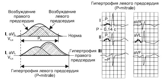 Гипертрофия правого и левого предсердия на ЭКГ. Признаки гипертрофии левого предсердия на ЭКГ. Гипертрофия левого предсердия на ЭКГ. Гипертрофия левого предсердия и левого желудочка на ЭКГ. Норма правого предсердия