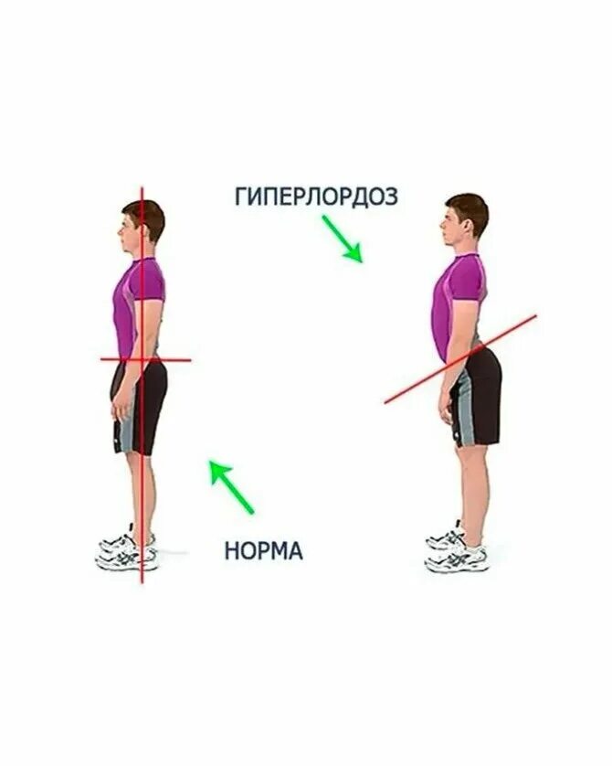 Как вылечить гиперлордоз. Гиперлордоз поясничного отдела. гиперлордоз поясничного отдела позвоночника. искривление позвоночника гиперлордоз. лордоз и гиперлордоз.