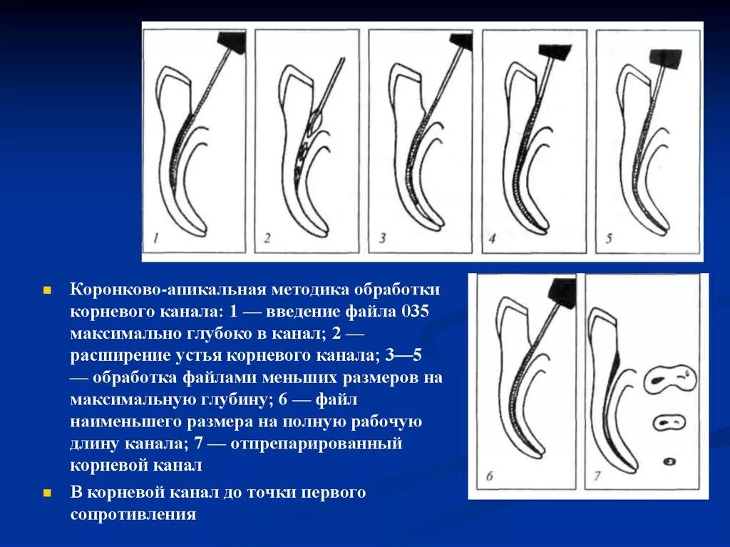 Определение корневых каналов. Методика расширения корневых каналов стандартной техникой. Методы прохождения и расширения корневых каналов эндодонтия. Инструментальная обработка корневого каналов зубов. Стандартная методика обработки корневых каналов.