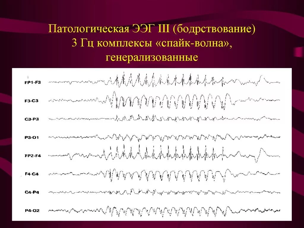 Ээг ответ. Комплекс Спайк медленная волна на ЭЭГ. ЭЭГ эпилепсия пик-волна. Доброкачественные эпилептиформные паттерны детства на ЭЭГ. ЭЭГ паттерны патологические.