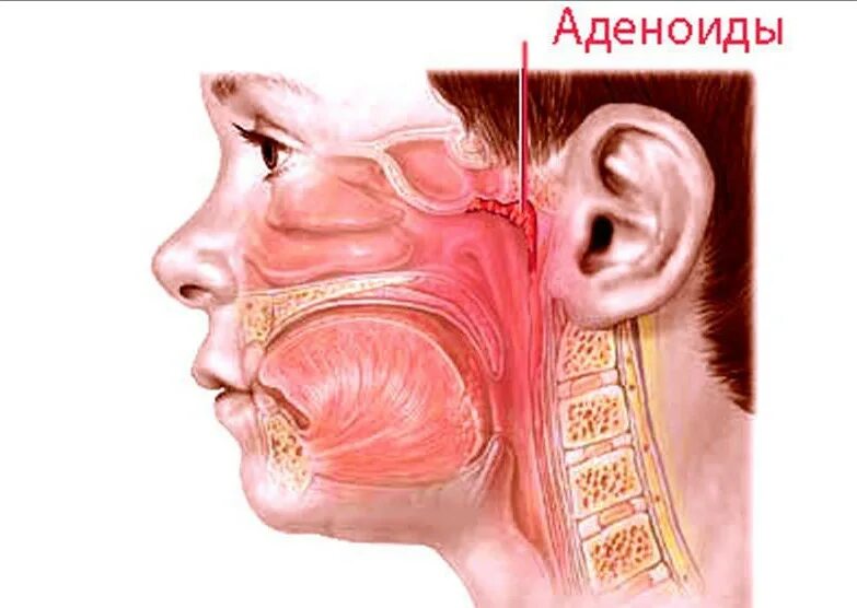 Аденоиды признаки. Аденоидные вегетации у ребенка (аденоиды).. Носоглоточная ткань (аденоиды). Анатомия носоглотки аденоиды. Аденоиды носоглоточные миндалины.