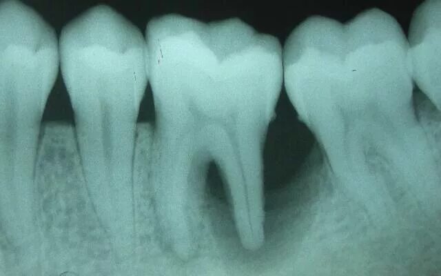 Фиброзный периодонтит. Фиброзный периодонтит рентген. Хронический фиброзный периодонтит рентген. Пародонтит зуба рентген. Острый фиброзный периодонтит.