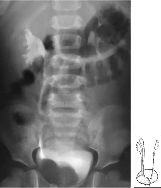 Удвоение мочеточника. Агенезия мочеточника рентген. Агенезия почки рентген. Расширение мочеточников у детей на экскреторной урограмме. Аномалии мочеточника у детей урограмм.