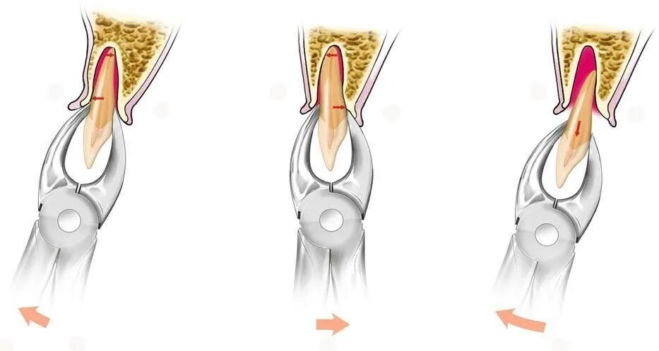 Корень зуба клык. Выдергивание корня зуба. Извлечение корня зуба элеватором. Отслоение круговой связки зуба. Этапы удаления корня зуба щипцами.