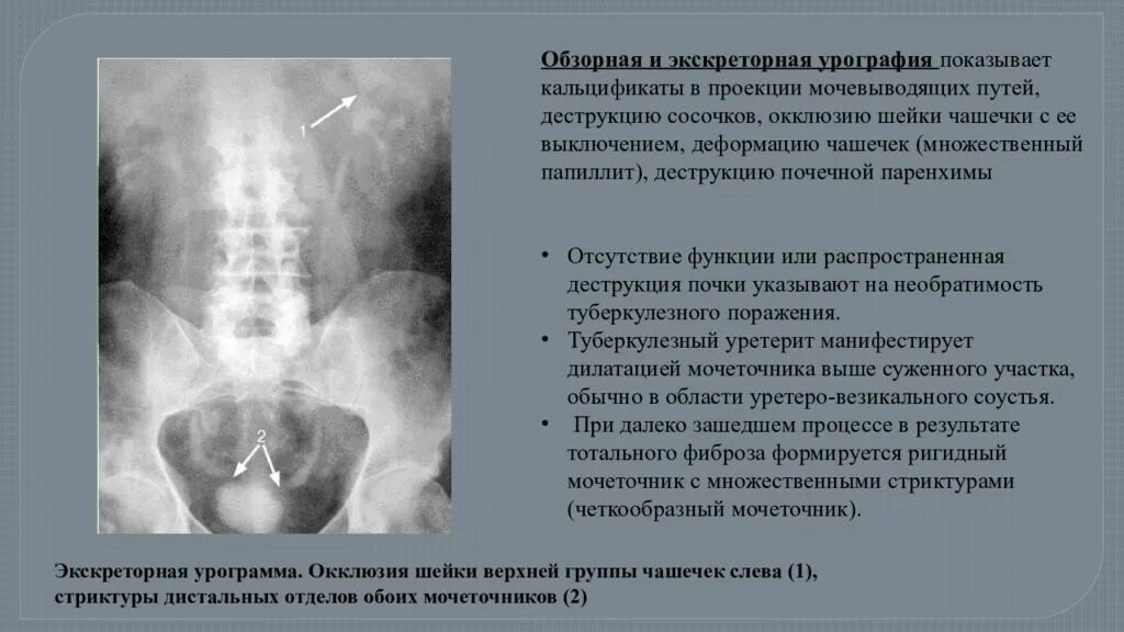 Мочеточник дистальный. Обзорная урография мочевыделительной системы. Обзорная и экскреторная урография. Обзорная урограмма. Обзорная выделительная урография.