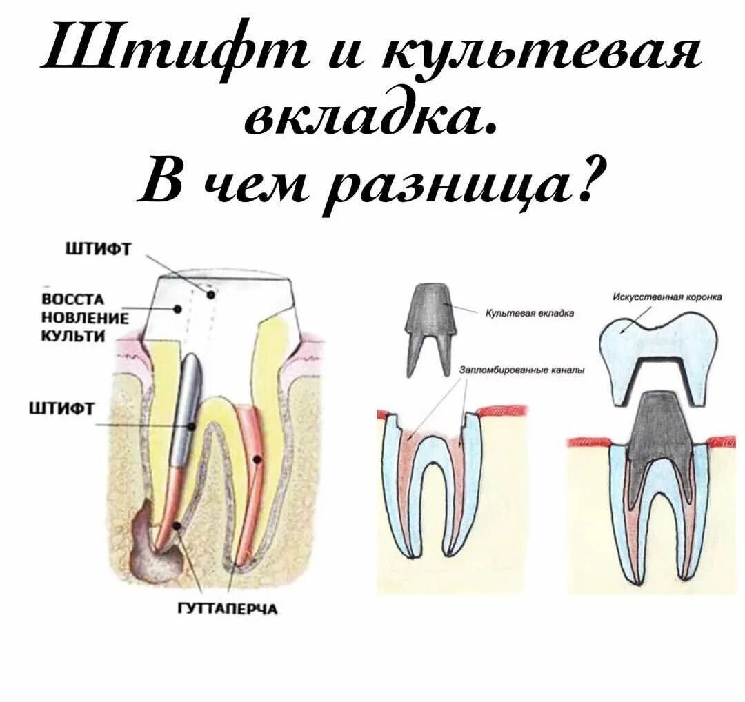 Штифт на зуб: установка зубной коронки или пломбы на штифте, протезирование паци