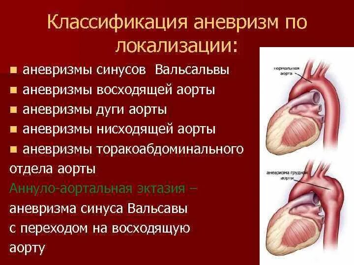 Аневризма сердца что это такое симптомы. Аортальный клапан синус Вальсальвы. Расширение синусов Вальсальвы норма. Расширение восходящего отдела аорты классификация. Аневризма синуса Вальсальвы.