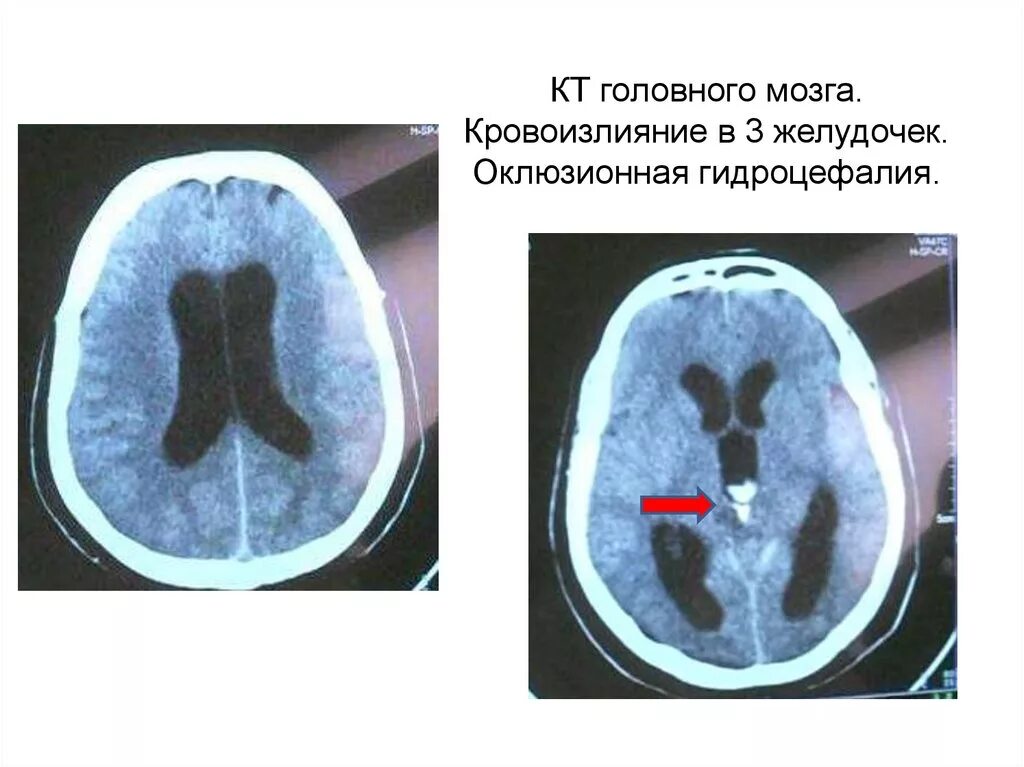 Гидроцефалия расширение желудочков. Гидроцефалия головного мозга на кт. Желудочки головного мозга кт анатомия.