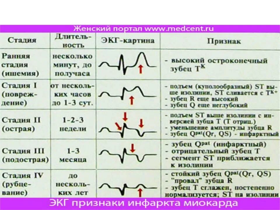 Норма форма сердца. Показатели давления при инфаркте миокарда. Показатели ад при инфаркте миокарда. Артериальное давление при остром инфаркте миокарда. Периоды инфаркта миокарда ЭКГ изменения.