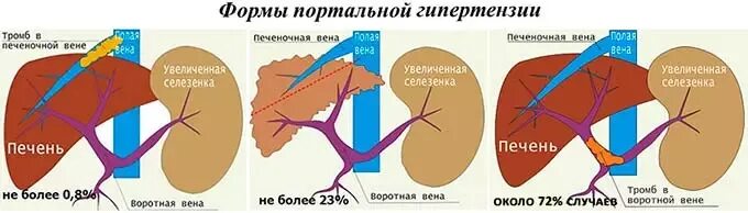 Тромб в печени