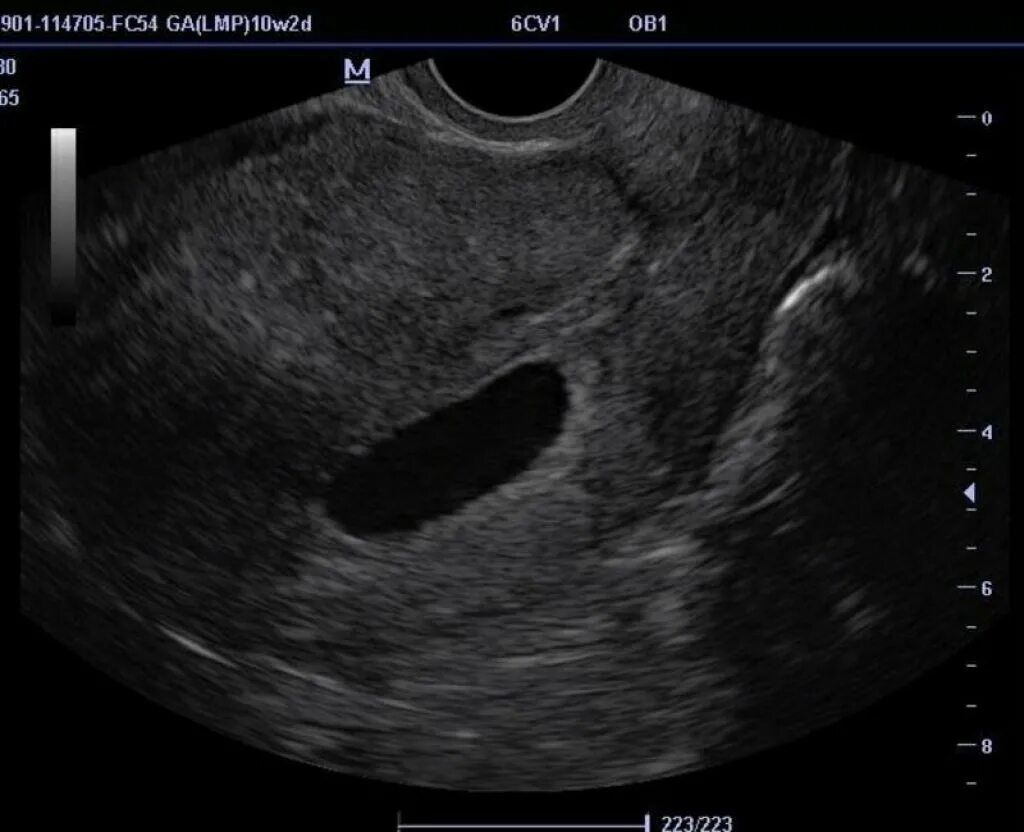 Можно ли определить замершую беременность. Неразвивающаяся беременность узи. Можно ли определить замершую беременность. Анэмбриония – пустое плодное яйцо. Можно ли определить замершую беременность.