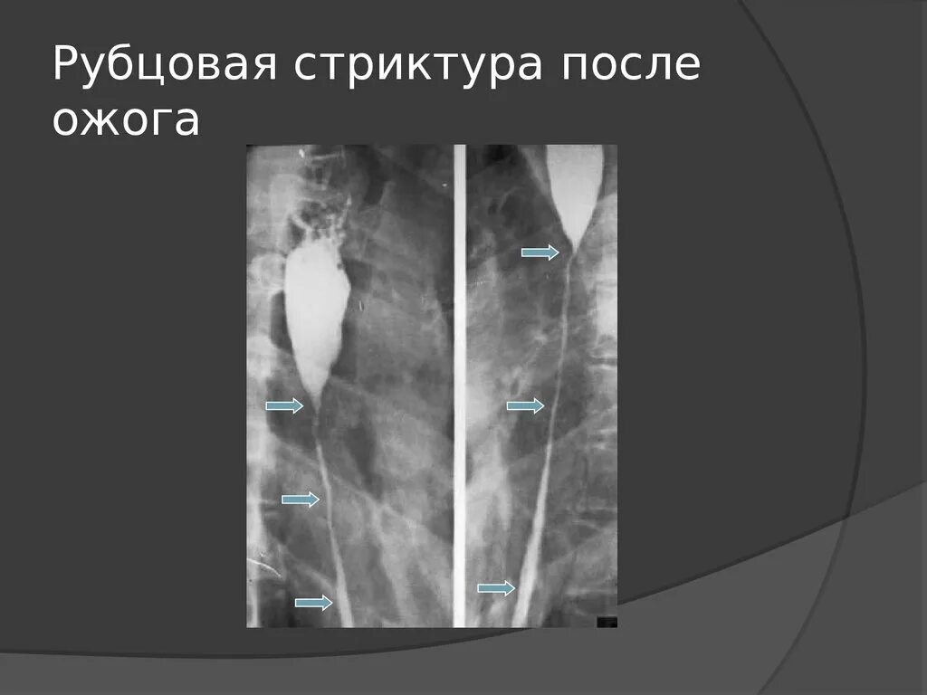 Рубцовые стриктуры пищевода операции. Рубцовая стриктура пищевода рентген. Рубцовое сужение пищевода рентген. Ожоговые стриктуры пищевода рентген. Рубцовые сужения пищевода