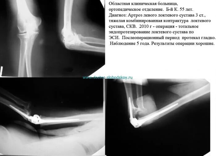 Контрактура локтевого сустава рентген описание. Артроз локтевого сустава 2 степени рентген. Контрактура локтевого сустава на рентгене. Артроз локтевого сустава рентген протокол. Посттравматический контрактура сустава