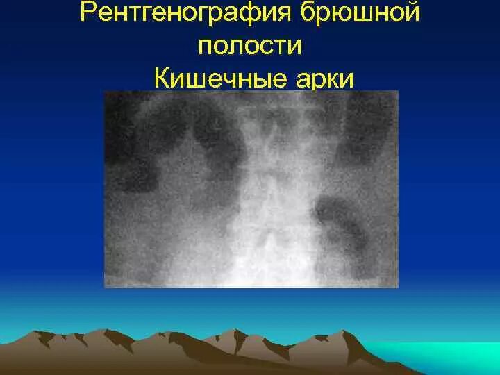 Уровень на рентгене. Уровень на рентгене