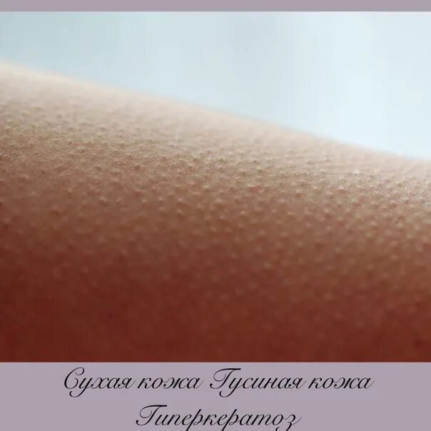 Против гусиной кожи. Фолликулярный гиперкератоз кожи. гиперкератоз гусиная кожа. гусиная кожа фолликулярный.