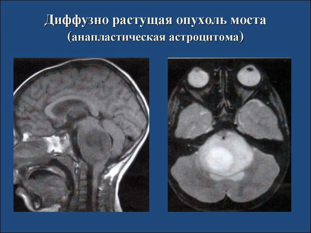 Опухоль головного мозга глиома. Средний мозг поражение. Диффузная опухоль ствола головного мозга. Опухоль продолговатого мозга мрт. Диффузная глиома ствола головного.